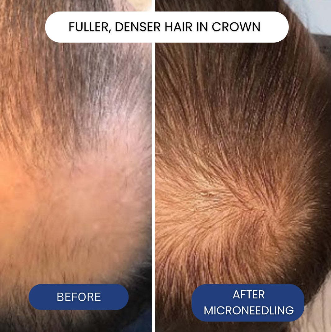 Hair Regrowth Microneedling GH - đánh giá và giá Peptide Complex Serum